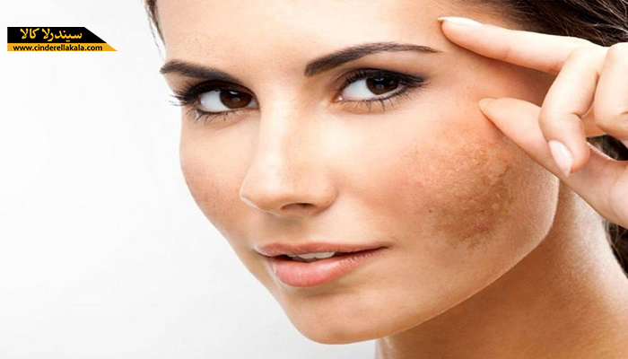 محصولات درمان کننده لکه های پوستی 