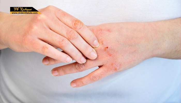 درمان خشکی پوست دست ها
